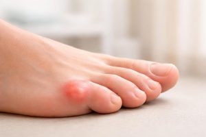 Petite Boule sur le Côté du Pied : Causes et Solutions