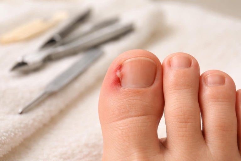 pied-ongle-incarne-outils-pedicure