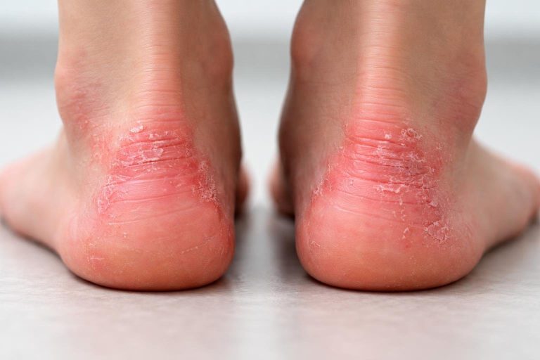 pieds-flous-rougeurs-zones-seches